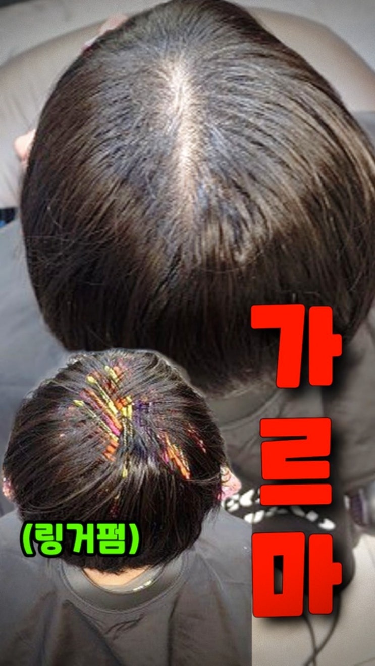  모류교정 링거펌으로 해결! 40대 단발머리 뒤통수 볼륨 살리는 방법