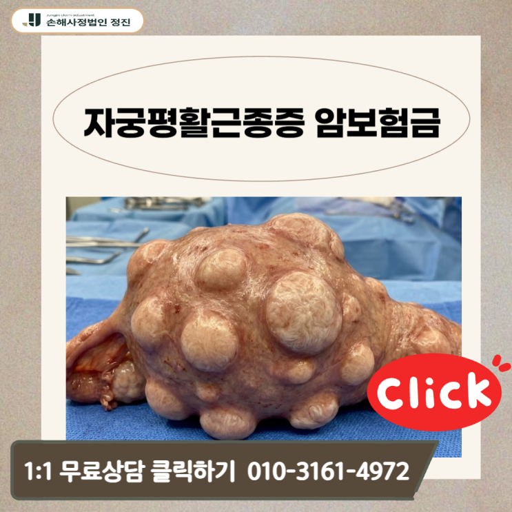  자궁평활근종증 암보험금, D25.9 코드인데도 전액 지급받은 비결은?