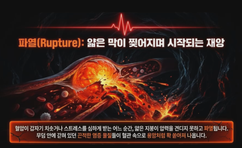 관상동맥 죽상경화증 뜻, 원인, 죽상이 되는 과정, 예방하는 구체적 생활 지침