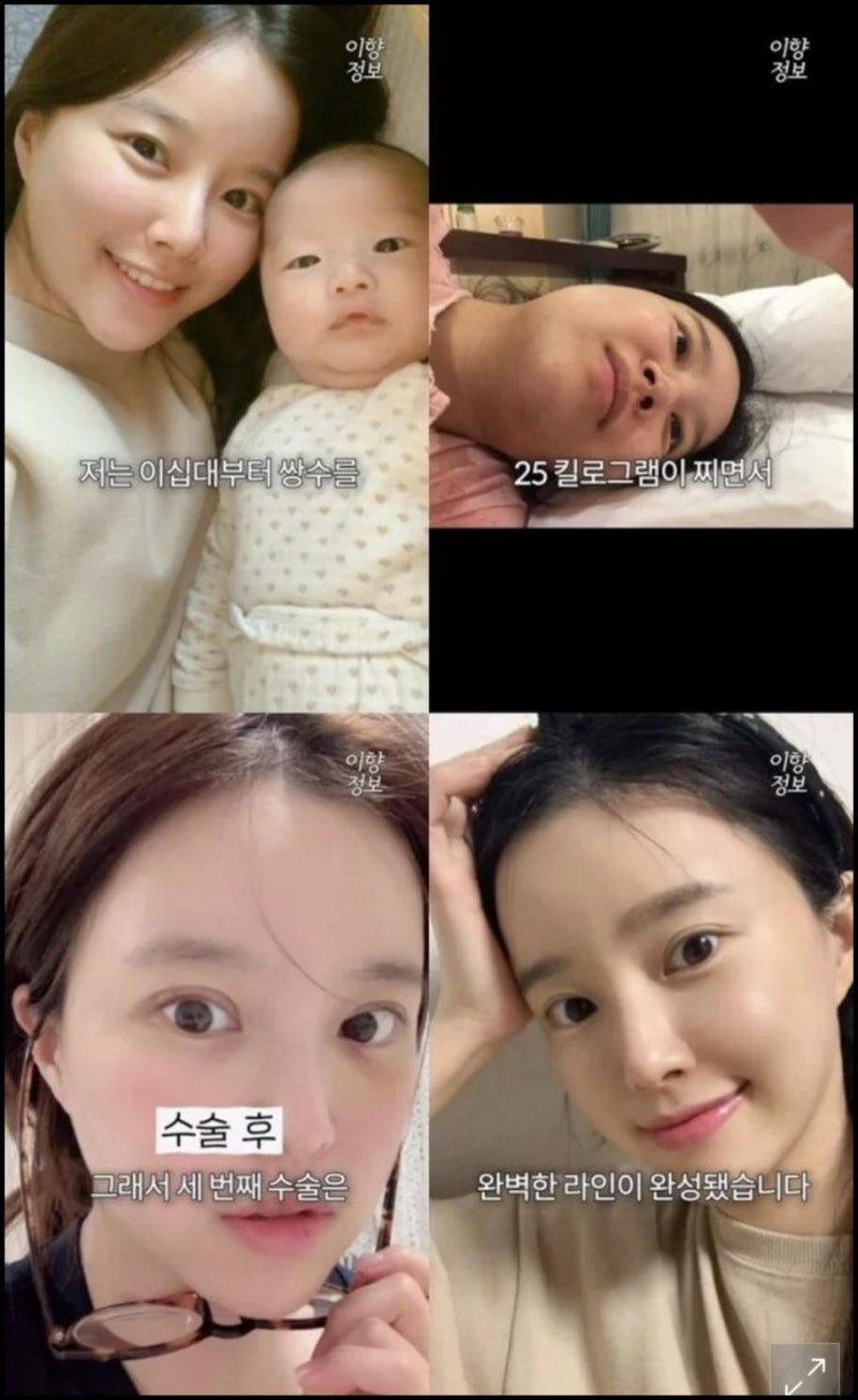"쌍꺼풀 수술 세 번, 임신 중 25kg 찌면서 라인 다 사라졌다" 아나운서 이향 충격 고백 비하인....