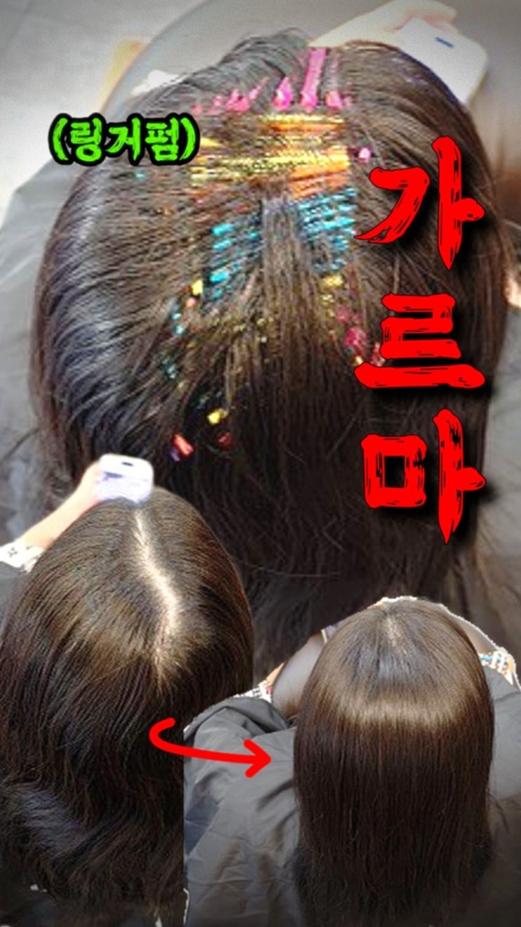  잠실 가르마 탈모 해결 후기, 수원까지 찾아온 링거펌으로 정수리 볼륨 살린 리얼 변화