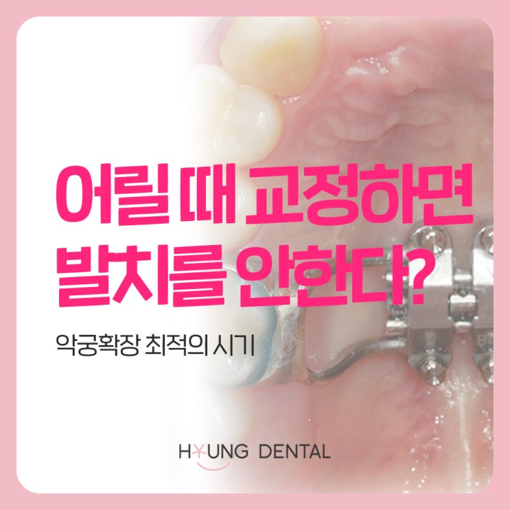  악궁확장 A to Z, 인계동 교정치과가 말하다