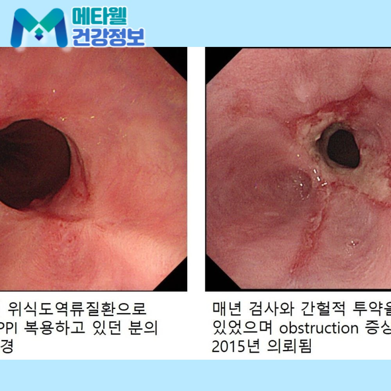 식도암 초기증상을 놓치면 말기가 됩니다, 원인과 치료까지 한번에