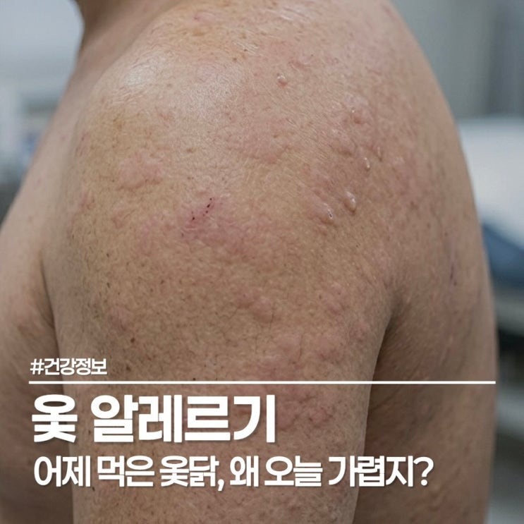  옻 알레르기 치료법과 예방, 무심코 먹은 옻닭 후 가려움 해결하기