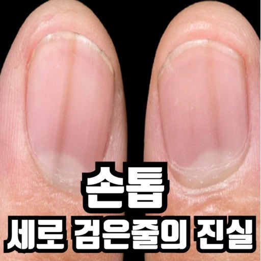 손톱 검은 세로줄, 설마 흑색종? 원인 6가지와 자가진단 위험 신호 총정리