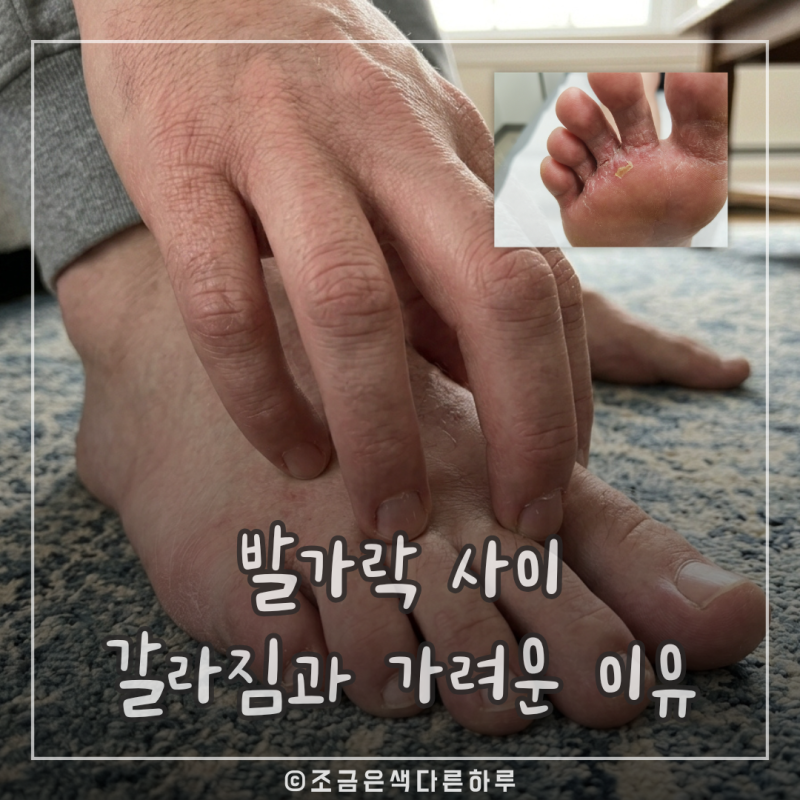 발가락 사이 갈라짐과 가려움 원인 5가지