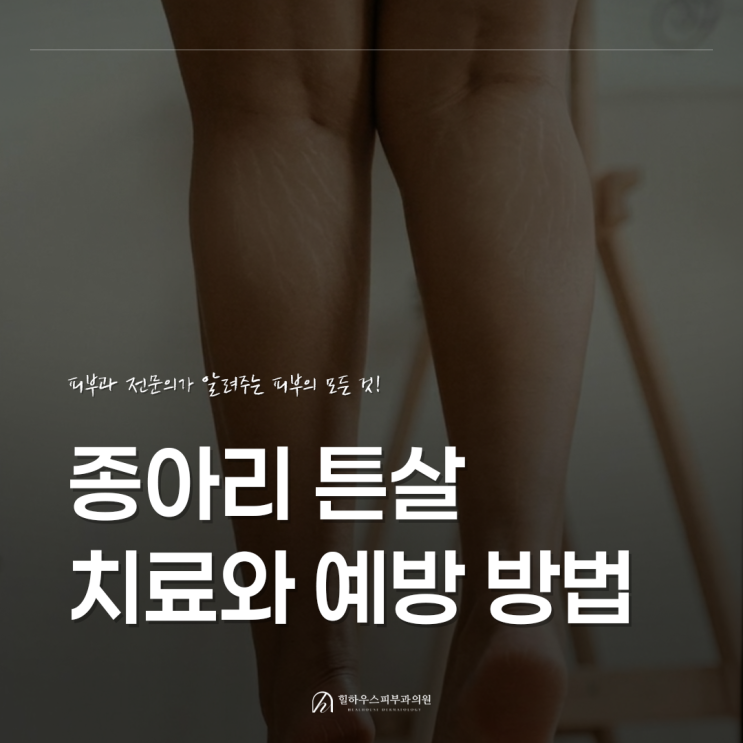  수원 종아리 튼살 치료와 예방 방법은 무엇인가요?