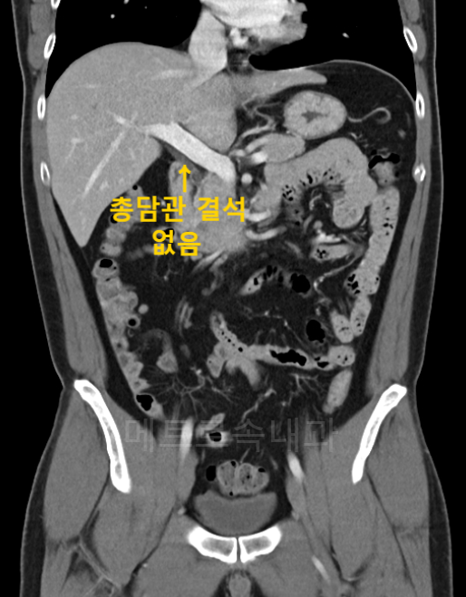 대구신천동내과) 복부초음파와 복부CT로 잡아낸 담낭의 이상신호