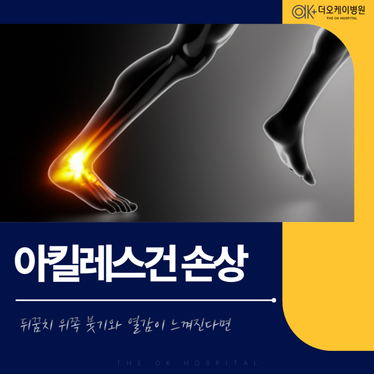  춘천 아킬레스건 손상, 뒤꿈치 위쪽 붓기와 열감이 느껴진다면