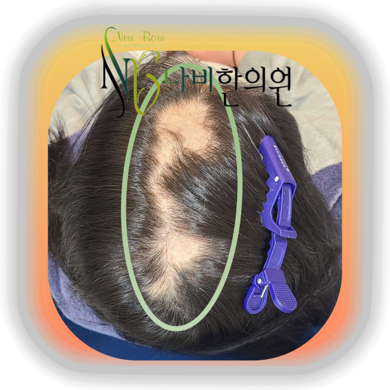 부산수험생원형탈모, 항상 긴장된 몸이 왜 원형을 멈추지 못하게 할까?
