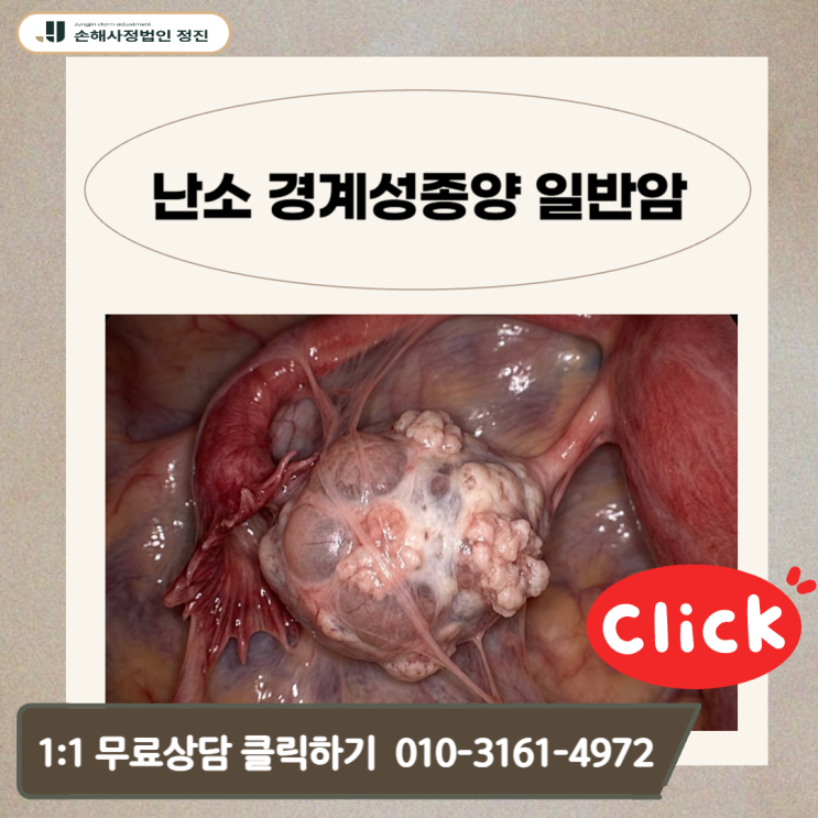  난소 경계성종양 일반암, 20%만 지급받았다면? 병리 소견으로 뒤집는 기준