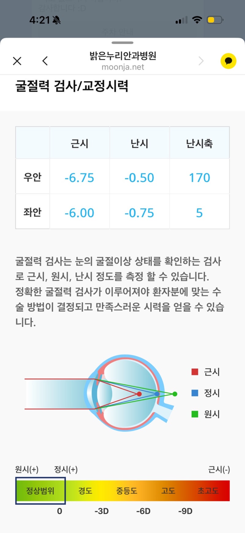 대전 밝은누리안과 스마일프로 한달 후기
