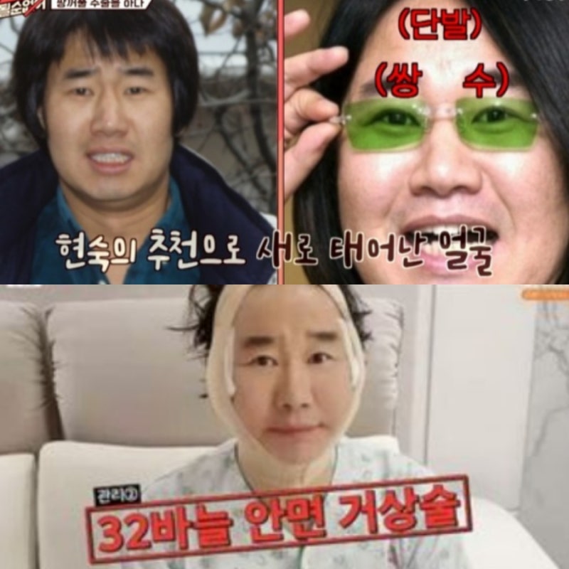 팽현숙이 폭로한 남편 최양락 성형 목록 총정리…박피 18번에 5200모 이식까지