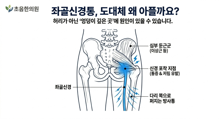  [좌골신경통] 허리 디스크가 아닐 수도 있습니다:  심부둔근증후군 대퇴좌골 충돌증후군