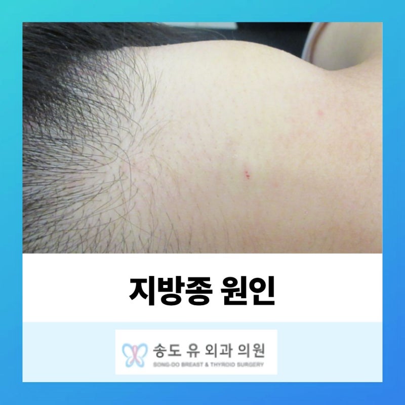 인천 송도 지방종 원인과 통증 정리, 제거 수술 꼭 해야 할까?