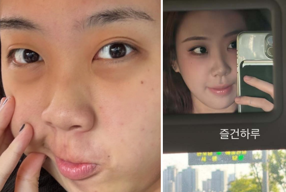 “4년 고민 끝에 했다더니…” 이영지 눈밑지, 어떤 사람이 해야 될까? 효과 3가지