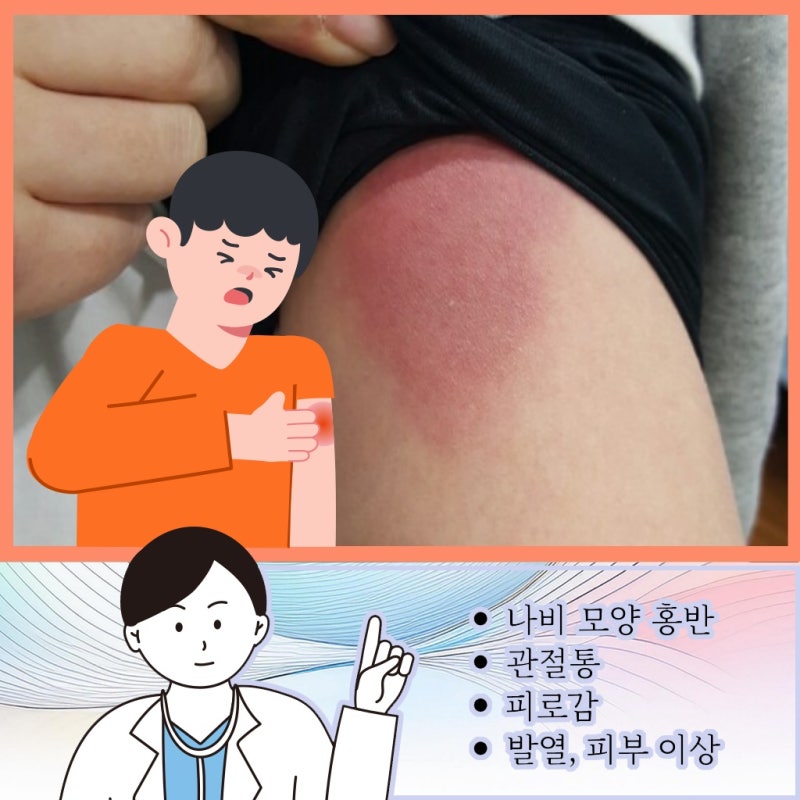 서울 강북 루푸스 원인 스트레스나 호르몬 변화가 영향을 주기도 합니다