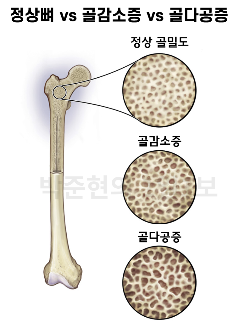 골다공증 이베니티 주사 비급여 처방, 실비 청구 가능할까? (T-점수 기준 총정리)