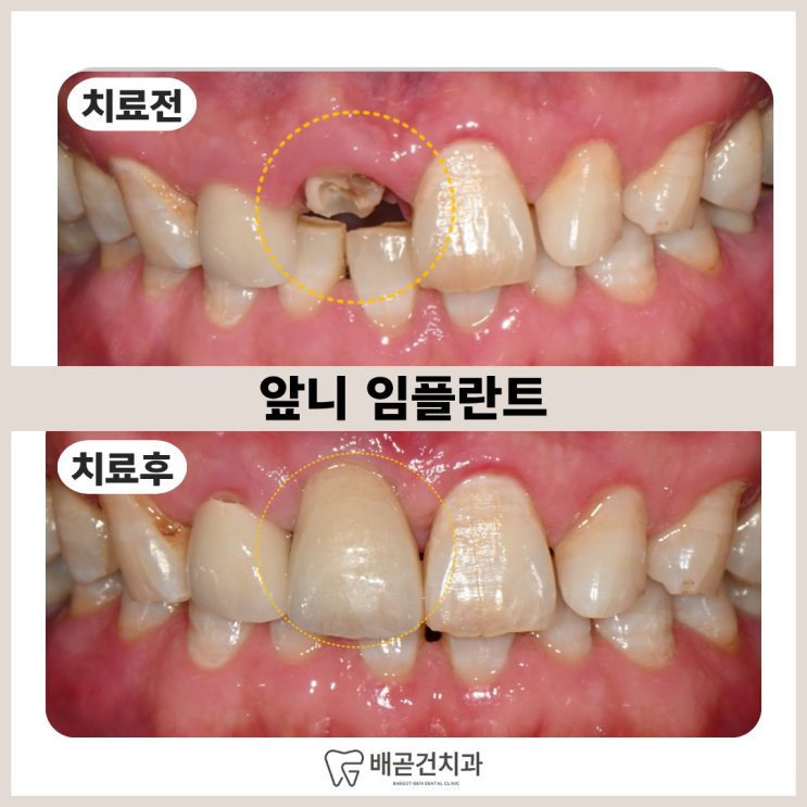  앞니 임플란트, 크라운 탈락인 줄 알았는데 치아가 부러진 경우