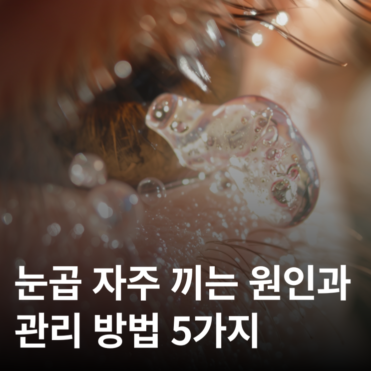  눈곱 많아지는 이유, 단순 피로 아닐 수도 있습니다