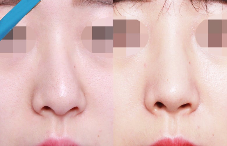 비중격만곡증 수술 비용, 받아야 하나 말아야 하나