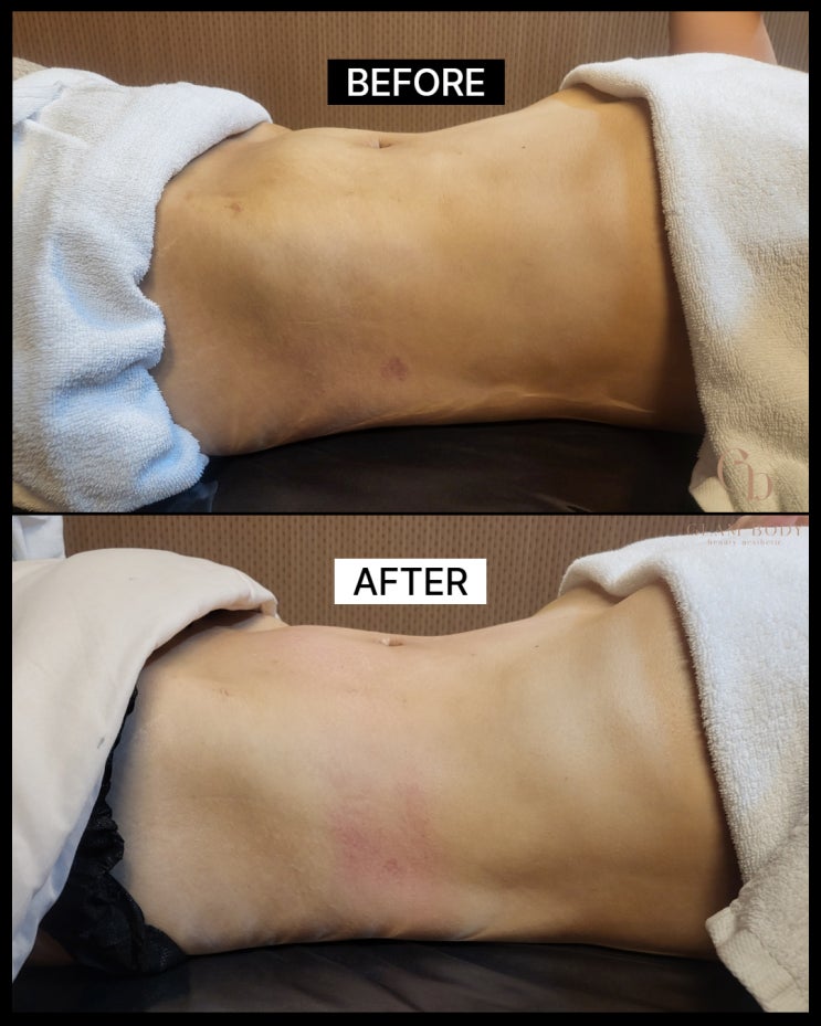  복부 지방흡입 바본, 왜 생길까요? 언제부터 관리해야 할까요