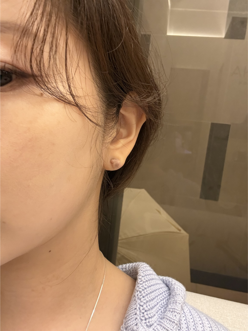 귀 켈로이드 제거 수술 후기 (2) - 실비 청구 후기