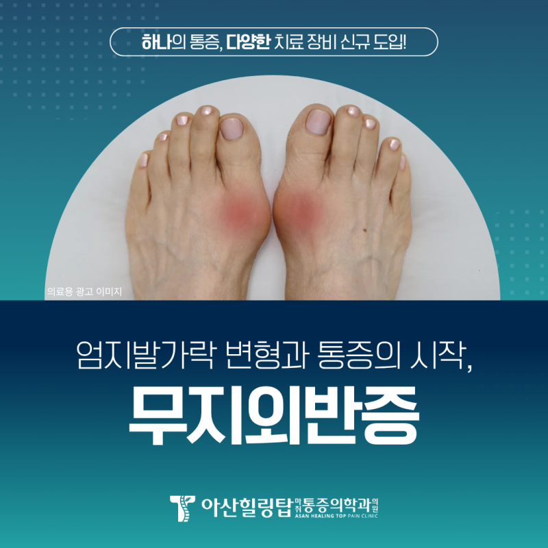 산본정형외과 무지외반증 방치가 무릎과 허리에 미치는 영향