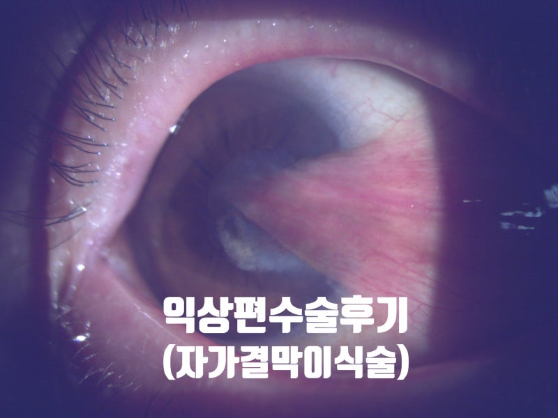 [대전 유성성모안과] 60대 익상편 수술 후기