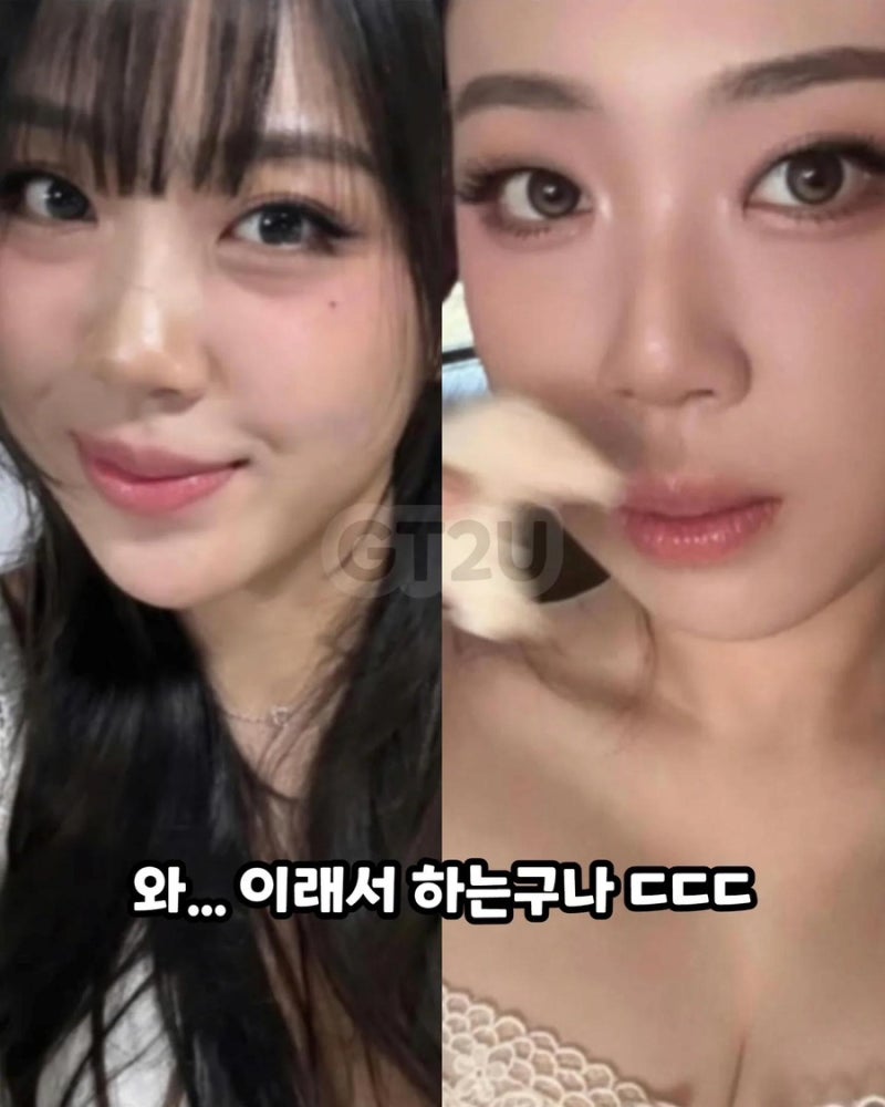 Lee Young-ji's Under-Eye Fat Repositioning: Which Hospital? Her Changed Vibe After the Procedure