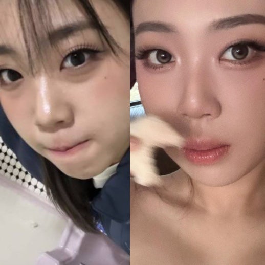 "Did Lee Young-ji Get Surgery?" Real Reactions to Her Under-Eye Fat Repositioning and the True Reason She Hid It for 4 Years