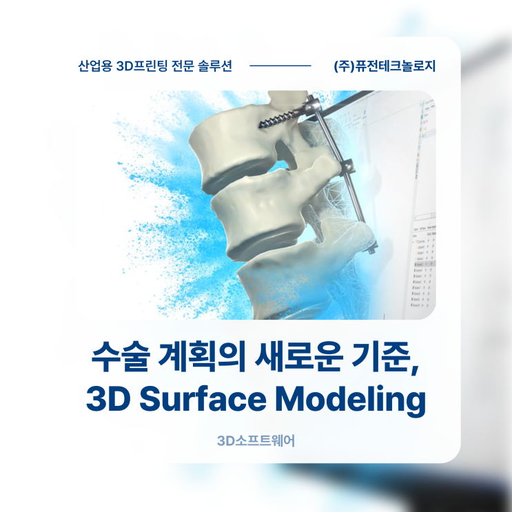 [Materialise S/W] 수술 계획의 새로운 기준, 3D Surface Modeling이 주목받는 이유