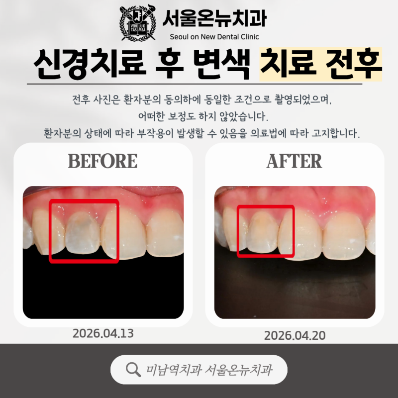 미남역치과, 신경치료 후 까매진 앞니, 크라운 없이 되돌리는 법?| 보존치료 실제 치료 사례 |....