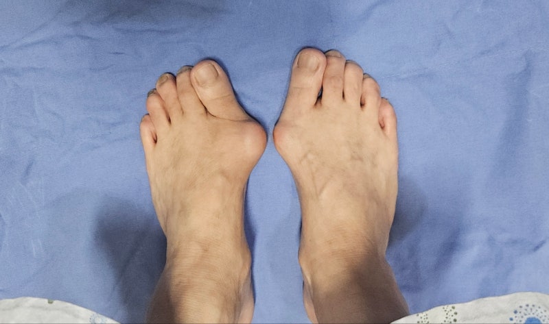 74세 여자 양측 무지외반증 수술 후 3개월 (광주 선한병원)