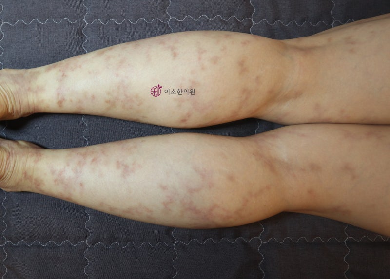 다리 얼룩 덜룩 그물 무늬, 하지정맥류? 망상청피반? 피부혈관염 자가진단, 치료법