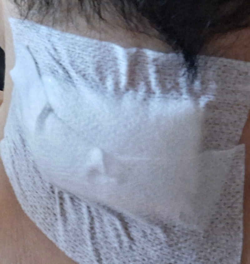 자꾸 재발하는 표피낭종, 완벽하게 제거하려면? (피부과? 외과?)