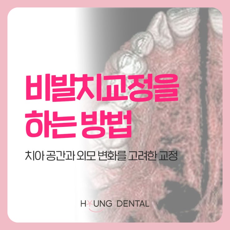  어릴 때 교정하면 무조건 비발치? 수원역 교정치과의 답은