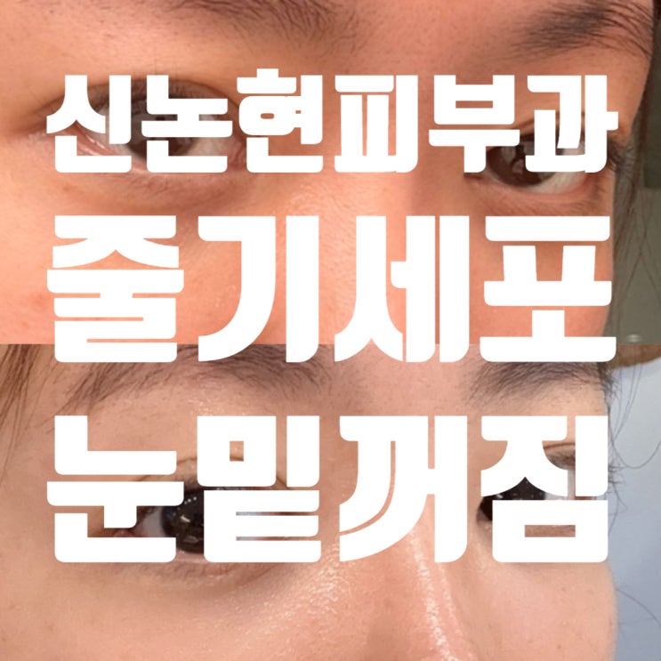  신논현 줄기세포 피부과 내돈내산, 눈밑꺼짐 마리오네트 받고 온 솔직 후기