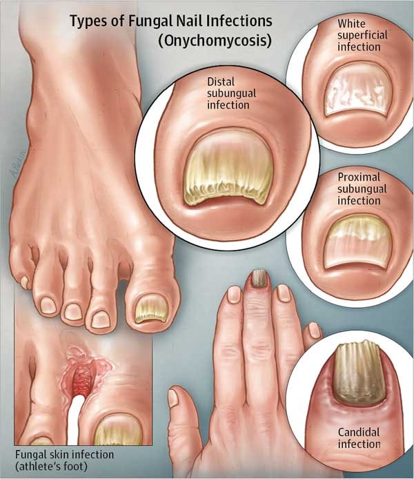 조갑진균증(Onychomycosis): 손발톱 무좀