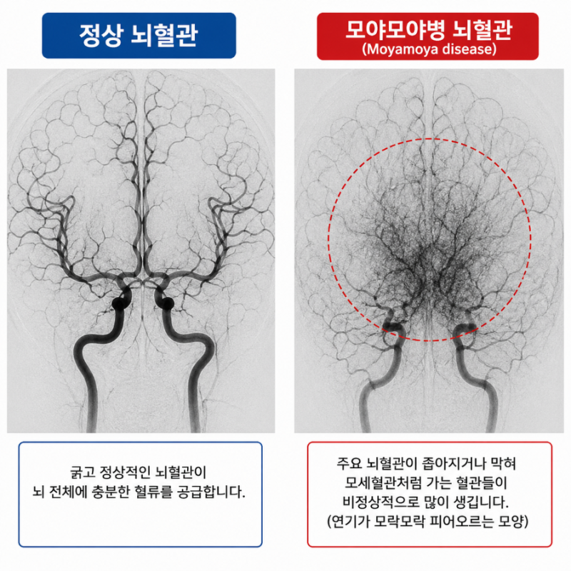 모야모야병 초기증상부터 치료까지 총정리! 아이,성인 모두 주의해야 하는 희귀 뇌질환