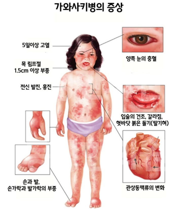 [NCLEX 아동 핵심요약] 소아에게 아스피린을? 가와사키병(Kawasaki) 합병증과 간호 중재