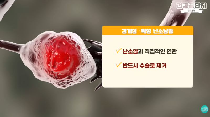 난소낭종 난소혹 난소물혹 증상 꼭 수술해야 하나요? 난소암 정확한 검사 방법은?