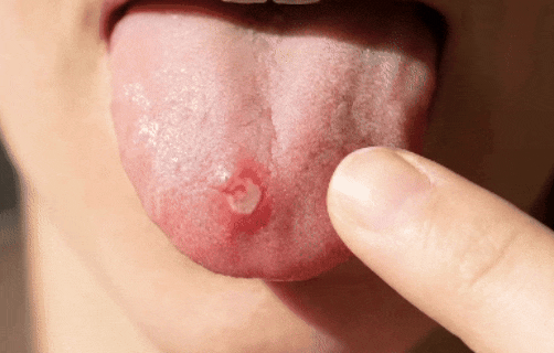 하얀 혓바늘 알보칠, 오라메디 발라도 될까요?
