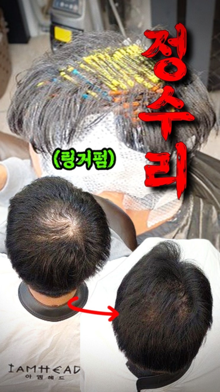  용인 수지 정수리 탈모 고민, 수원 율전동 링거펌으로 해결한 리얼 후기