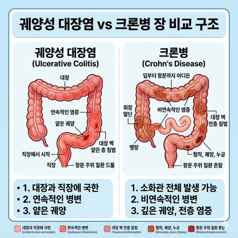 만성 염증성 장질환 완벽 정리! 궤양성 대장염,크론병 증상부터 치료,식단까지 총정리