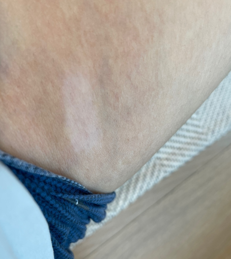 백반증 커버제, 성분을 봐야 하는 이유 : 멜터치