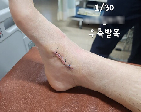 부주상골 증후군? 악세사리뼈? 부주상골이 있으면 꼭 수술해야 하나요?