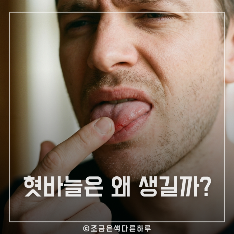 혓바늘 자주 생긴다면 꼭 보세요