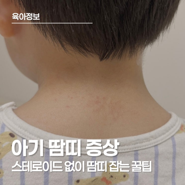  아기 땀띠 증상, 두드러기와 헷갈린다면?
