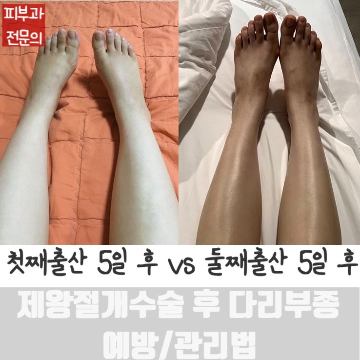  제왕절개 출산 후 다리부종이 생기는 이유, 예방법, 관리법 (압박스타킹/산후마사지/공기압마사지/식단)
